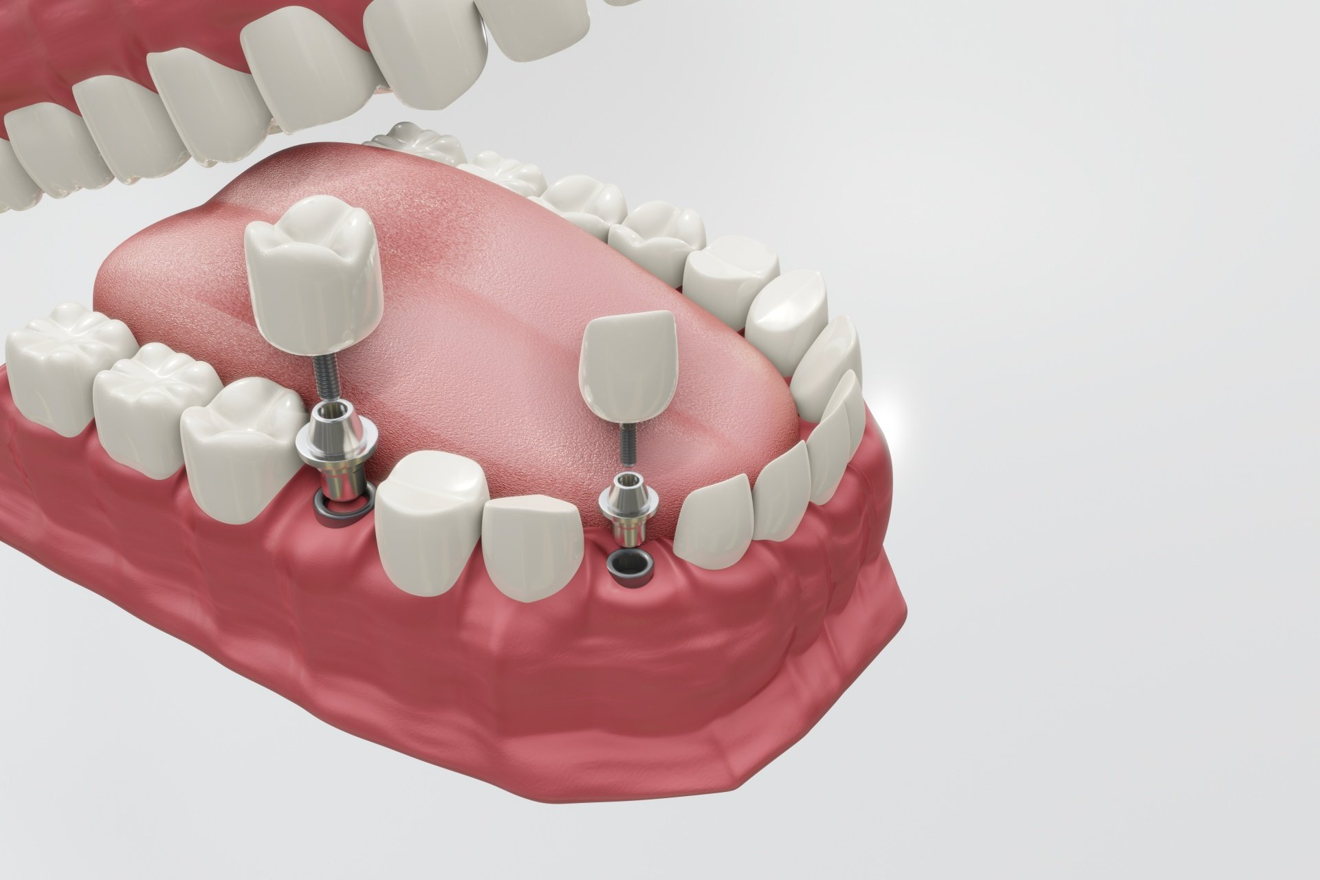 Ilustração educativa de implantes dentários
